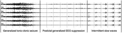 A hybrid unsupervised and supervised learning approach for postictal generalized EEG suppression detection